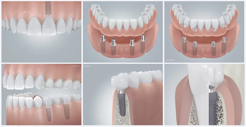 Implantate
